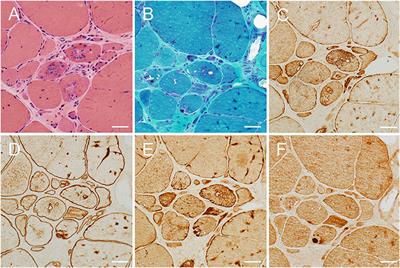 Novel Desmin Mutation Causing Myofibrillar Myopathy in a Hmong Family